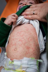 Infant w/ measles