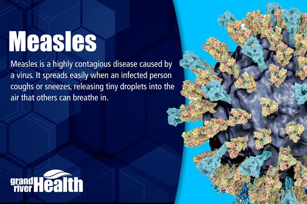 Read more about the article Measles